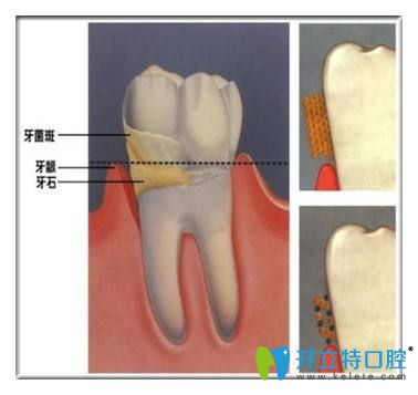 牙結(jié)石的危害你知道嗎？告別牙結(jié)石可以用這7種方法