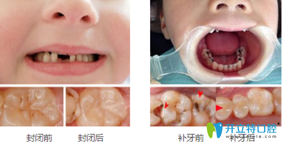 兒童在<!--<i data=20240703-sp></i>-->口腔治療前后效果對比照片