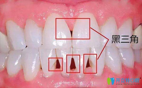 矯正牙齒出現(xiàn)黑三角能恢復(fù)嗎?牙齦萎縮是黑三角的真正原因