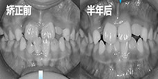 分享7歲兒子在成都金琴口腔做地包天矯正價格及真實經(jīng)歷