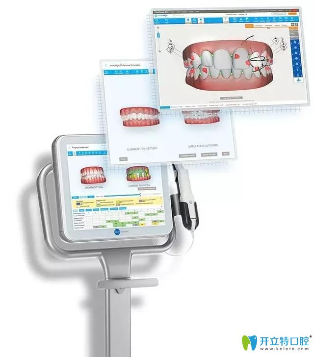 隱適美itero口內(nèi)掃描儀 黑科技PK傳統(tǒng)牙科石膏取模