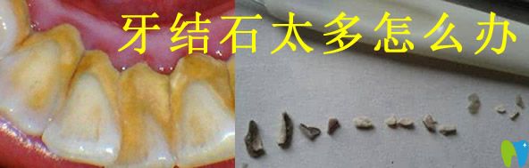 牙結(jié)石的形成原因及危害  并分享超聲波潔牙價(jià)格供你參考