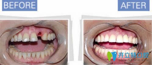 西安諾貝爾單顆牙缺失案例對(duì)比效果圖