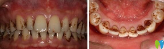  求助!牙齒煙斑怎么去除,單洗牙能去掉嗎？