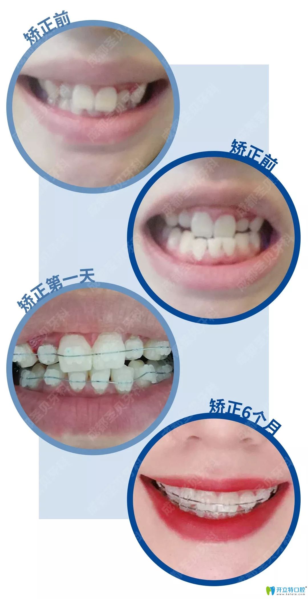 圣貝牙科牙齒不齊矯正1-6個(gè)月變化過(guò)程照片