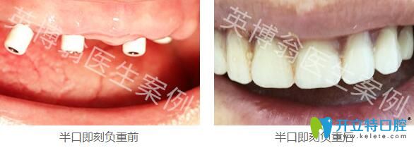 看我找上海英博口腔翁弘元花3999元做的韓國種植牙效果怎樣