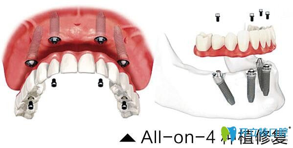 看65歲顧客在常州北極星口腔做的All-on-6半口種植牙效果好不