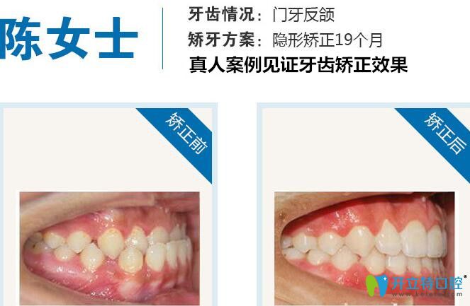 北京瑞鯊口腔地包天矯正案例