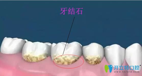 長了牙結(jié)石怎么辦?簡單實(shí)用的去牙石小偏方送給大家