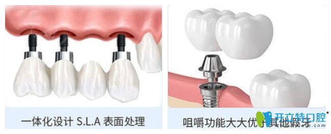 正夫口腔進口種植體的優(yōu)勢