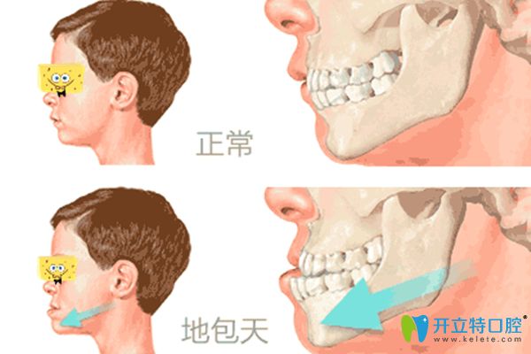 小孩地包天矯正多少錢?分享兒童戴牙套費(fèi)用及矯正器種類圖