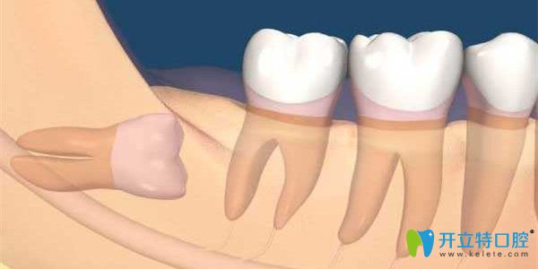 阻生智齒萌出空間不足盡快拔掉