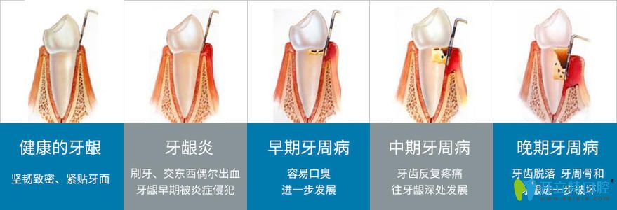 牙周疾病的發(fā)展