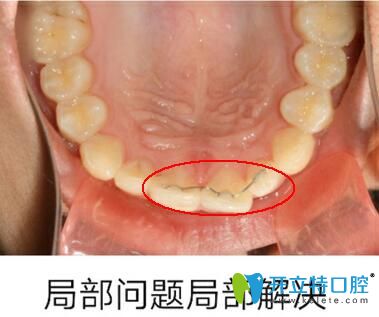 微管矯正單顆牙齒不齊