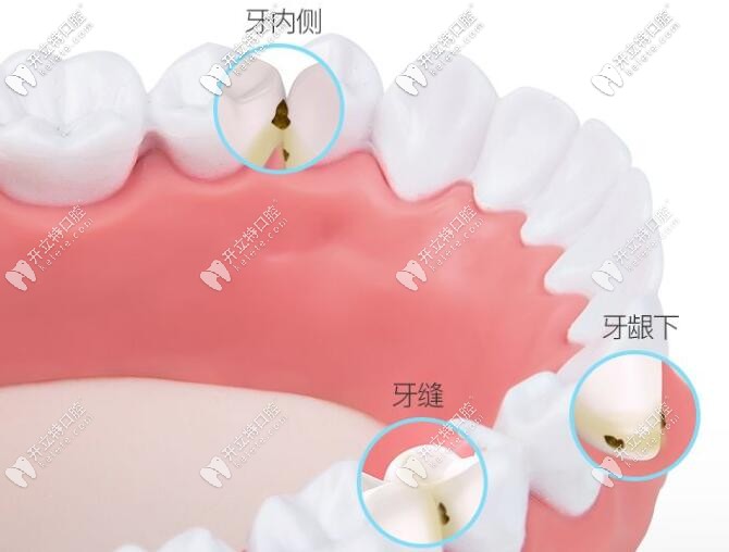 沖牙器能深入清理出牙縫的污垢