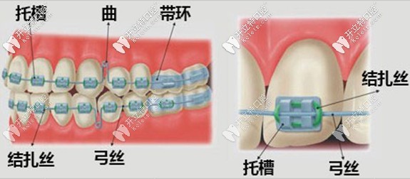 合理地選擇和替換槽溝內(nèi)的弓絲才是獲得治療效果的關(guān)鍵。