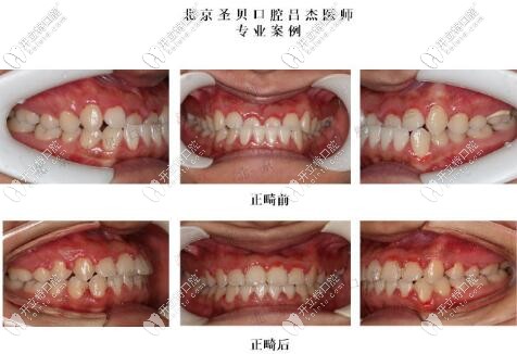 北京圣貝口腔呂杰醫(yī)師隱適美矯正案例