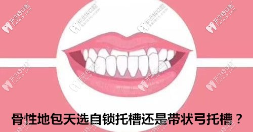 據(jù)說(shuō)骨性地包天用全同步帶狀弓矯正比戴自鎖牙套好?真or假