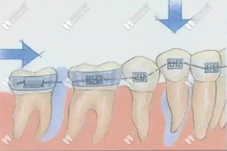 做牙齒矯正老了牙齒會變的松動嗎