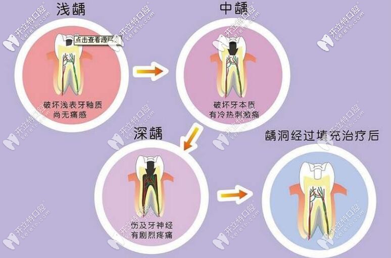 齲齒發(fā)展過程