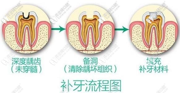 蛀牙別拖久喲!偷偷告訴你杭州做3M樹脂補牙的價格在這！