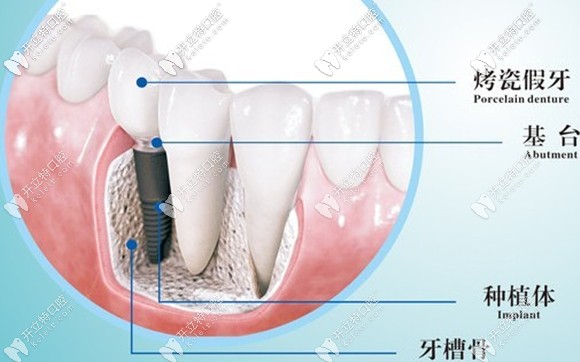 種植牙的結(jié)構(gòu)示意圖