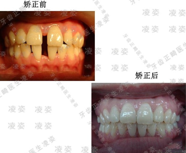 到上海圣貝口腔戴時(shí)代天使單膜,解決了4mm大的門(mén)牙牙縫問(wèn)題