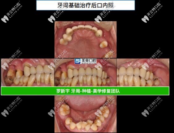 ?55歲重度牙周炎,成功在無(wú)錫美奧做了全口即刻負(fù)重種植牙