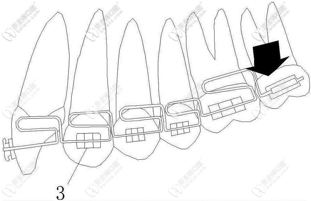 直絲弓矯治技術(shù)預(yù)覽