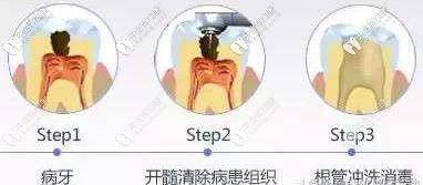 根管治療的意義