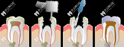 根管治療的過程