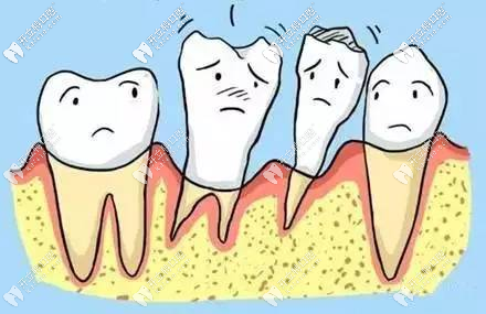 牙周病導(dǎo)致牙齒松動(dòng)影響正畸