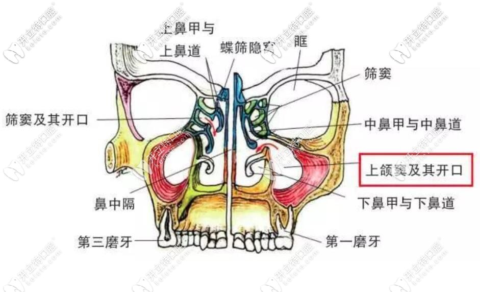 答疑:怎么判斷上頜竇穿孔？種植牙上頜竇穿透了會(huì)自愈嗎？