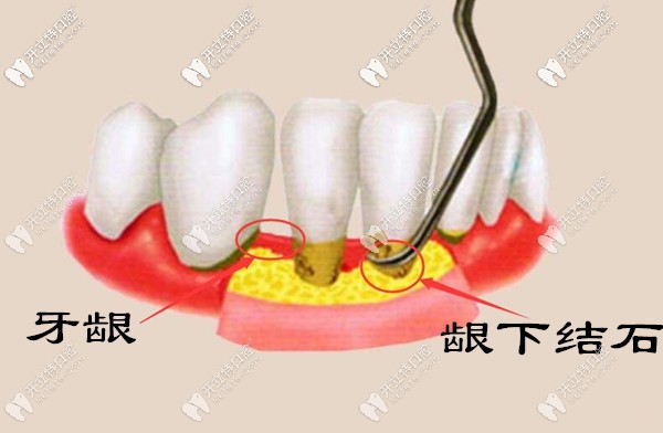 為什么牙結(jié)石會(huì)長到牙齦里面？齦下牙結(jié)石怎么處理？