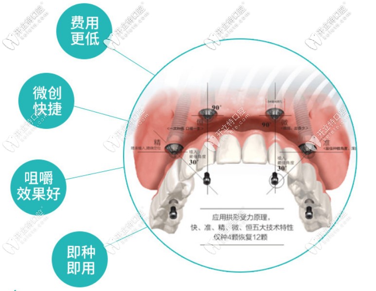 成都團(tuán)圓口腔做韓國(guó)登騰半口即刻負(fù)重種植牙的價(jià)格上線啦