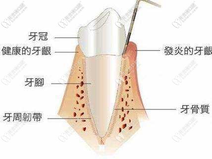 如何確定自己是牙髓炎