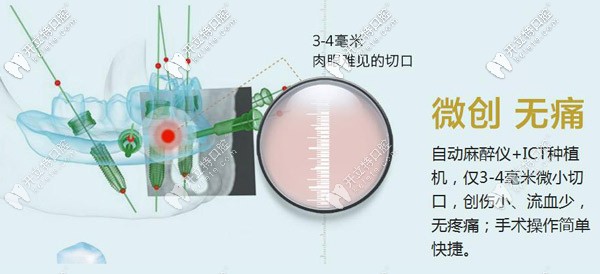 微創(chuàng)種植牙技術(shù)