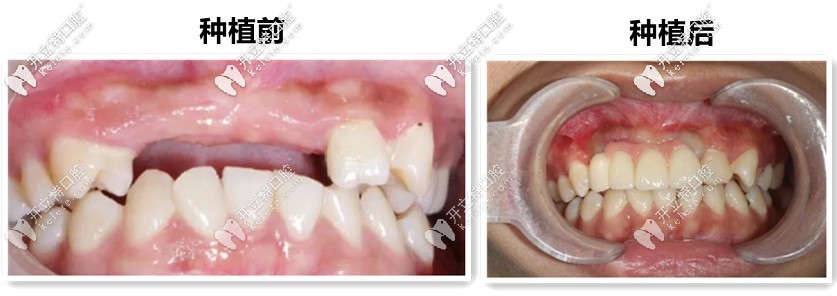 19歲妞門牙缺失4個(gè),來吐槽“鄭州唯美口腔”的種植牙技術(shù)