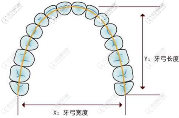 8-14歲的兒童使用牙齒擴弓的費用大概是多少？